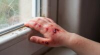 critical importance of burns